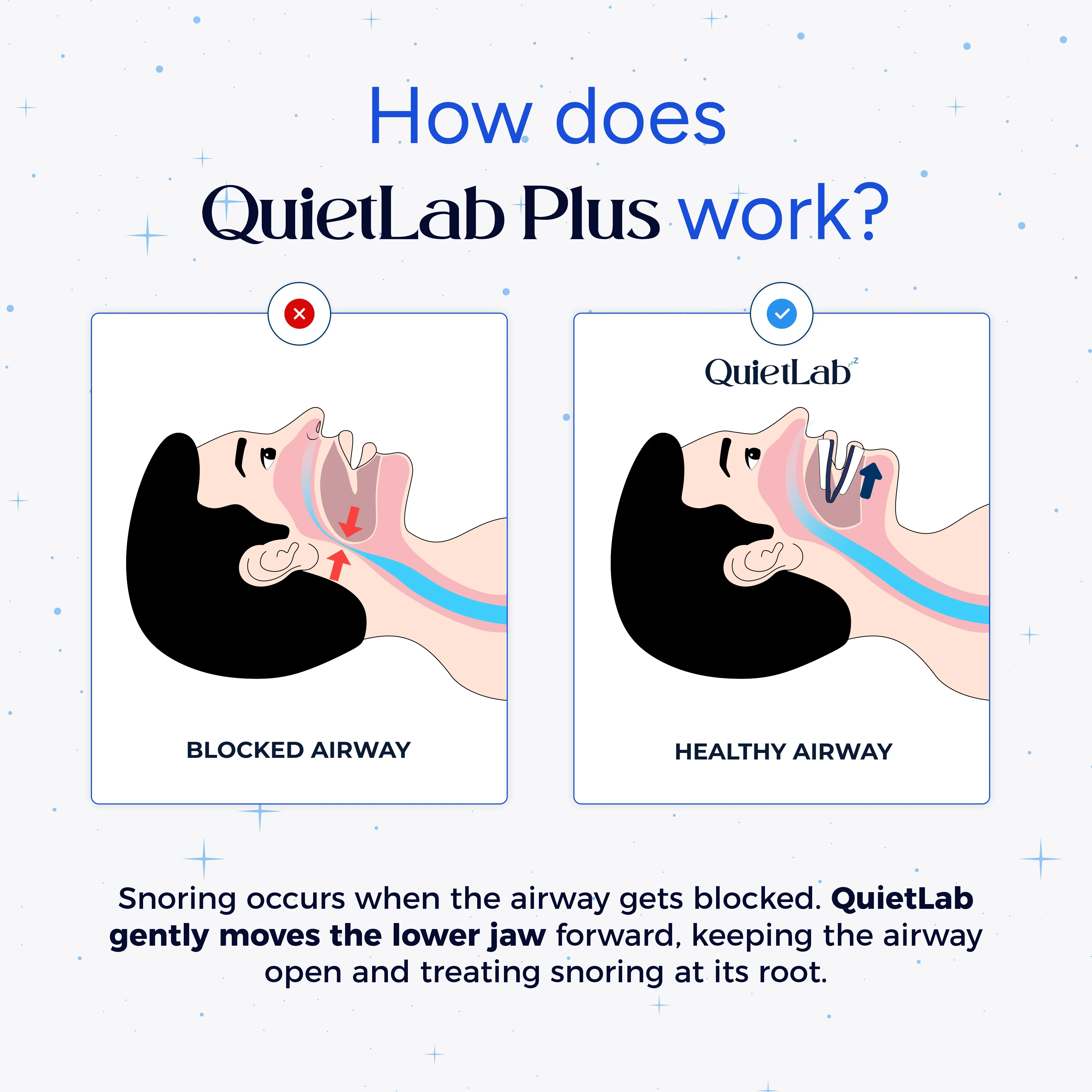 QuietLab Plus® Adjustable Anti-Snoring Mouthpiece - Image 5
